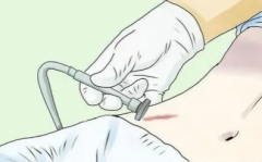 剖腹产疤痕增生激光可以去除吗
